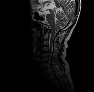 MRI Spinal Cord (Spine) Scan in Culver City, CA