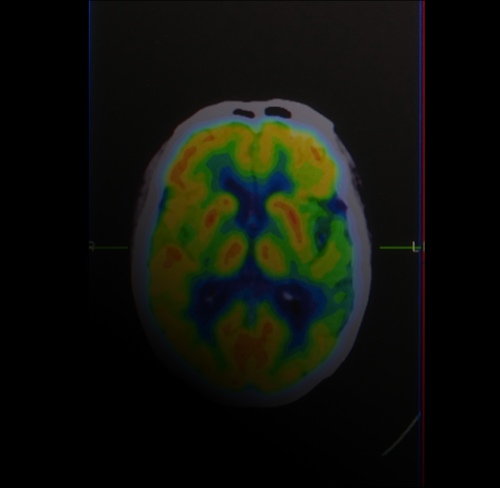 Brain PET