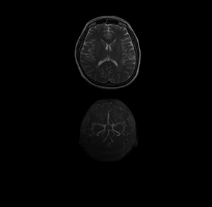 MRI & MRA Brain in Culver City, CA