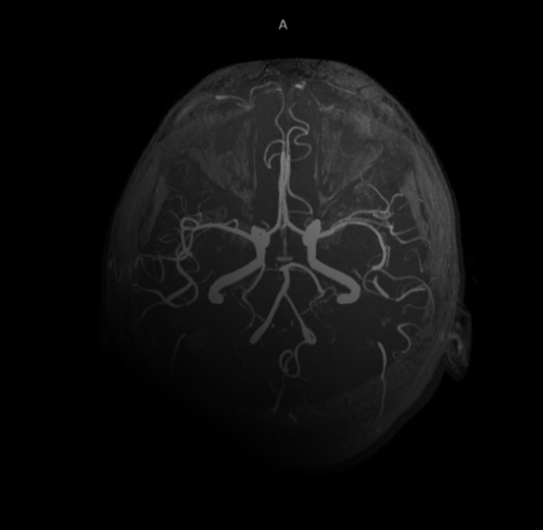 MRA Brain