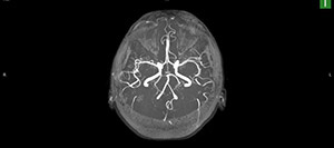 MRA Brain Screening Near Me in Culver City, CA MRA Brain Screening Near Me in Culver City, CA