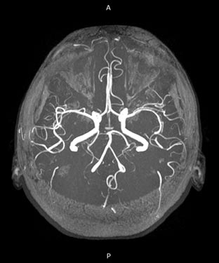 MRA Brain Screening Near Me in Culver City, CA