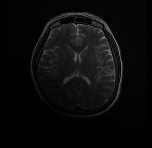 MRI Brain