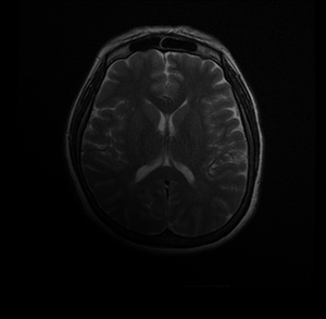 MRI Brain in Culver City, CA
